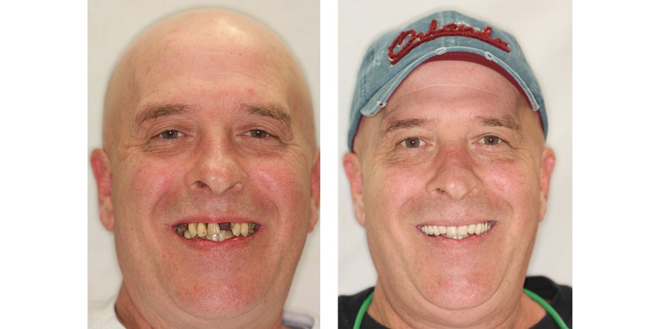 What is Full-Mouth Rehabilitation? 1