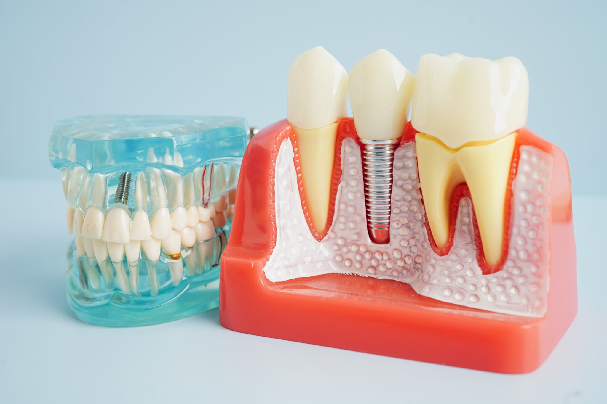 Implant Dentist Hickory