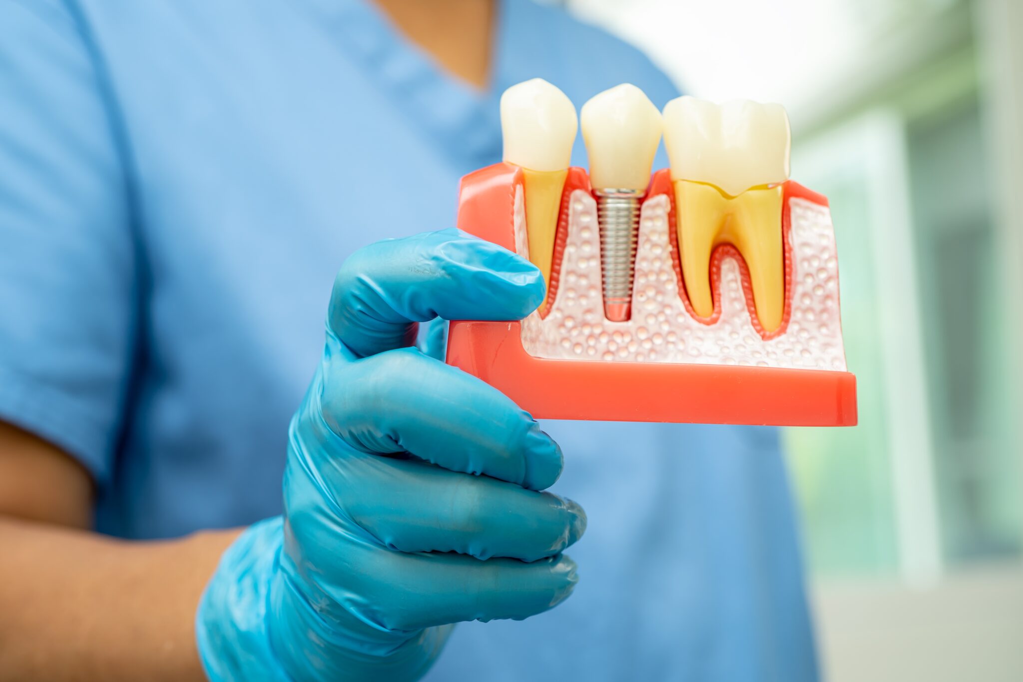 Dental Implants Hickory