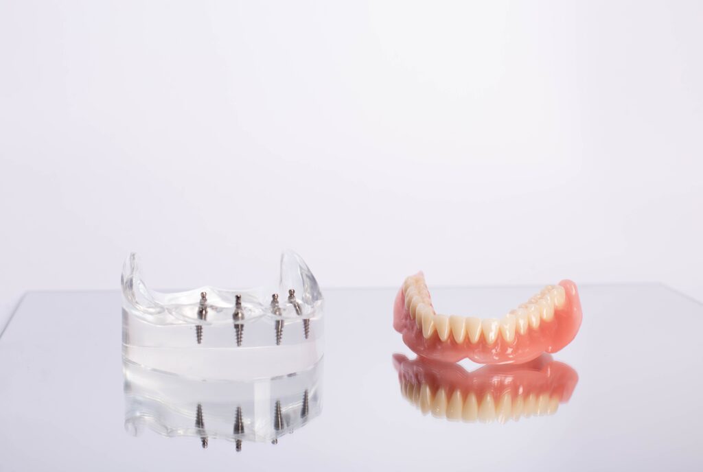Implant-Supported Dentures Hickory